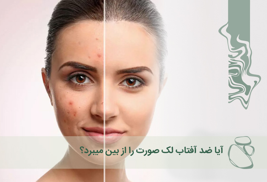 آیا ضد آفتاب لک صورت را از بین می‌برد؟